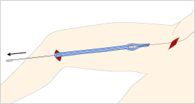ストリッピング手術