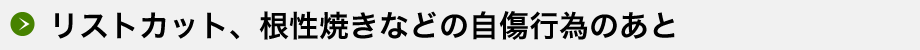 リストカット、根性焼きなどの自傷行為のあと