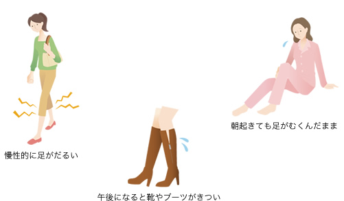 下肢静脈瘤の症状