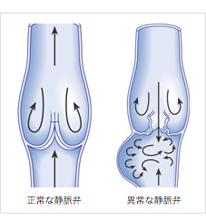 A下肢静脈瘤ではありませんか_r5_c2