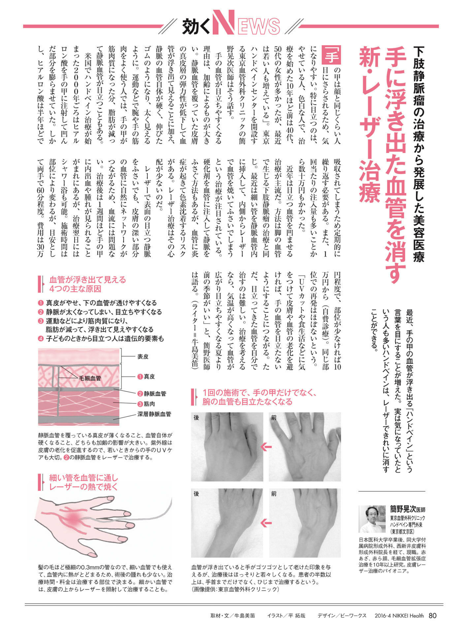 ハンドベイン 手の血管拡張症 東京血管外科クリニック