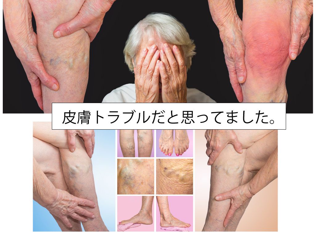 うっ滞から起こる皮膚疾患 東京血管外科クリニック